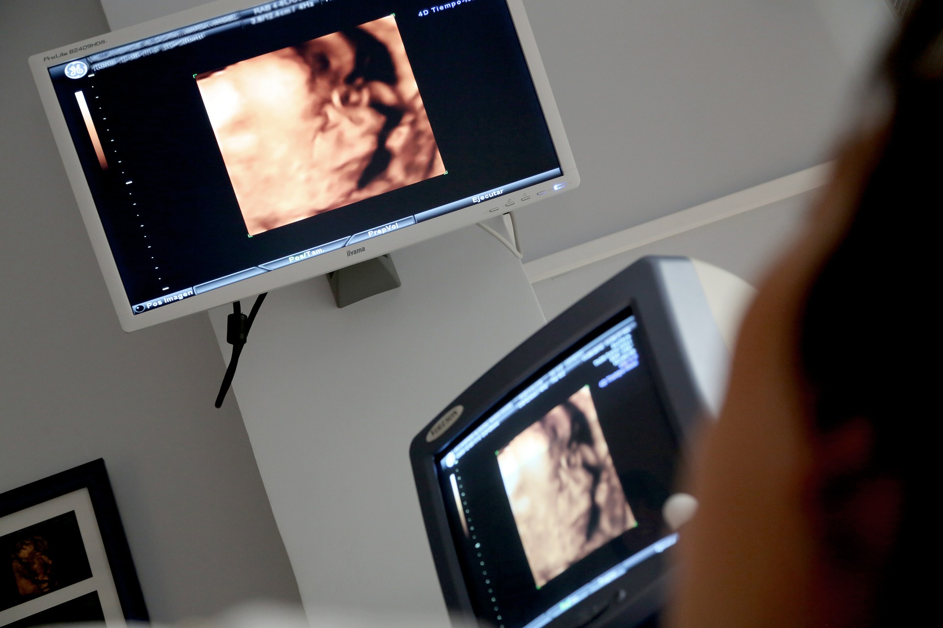 risks of ultrasounds